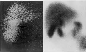 Liver and gallbladder HIDA scan nuclear medicine images