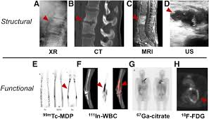 Infection detection multimodal imaging panel with structural and nuclear functional scans