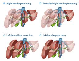 Medical illustration of liver cancer surgery and hepatic resection approaches