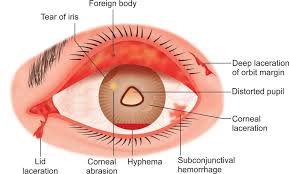 Eye injuries — diagram showing lacerations, abrasion, foreign body, and hemorrhage