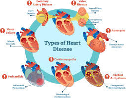 Cardiac disorders infographic highlighting common heart diseases and affected heart structures