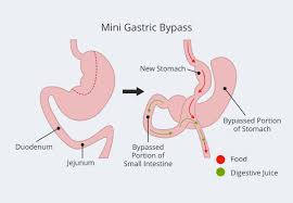 Mini gastric bypass diagram showing stomach and intestine before and after surgery