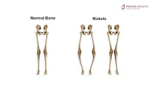 Pediatric bone disorders