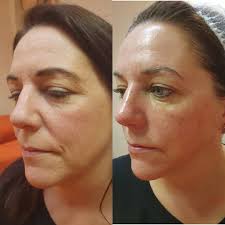 Before & after with this amazing Skin Booster facial. Ring Lir Spa  047-72929 for all inquiries.