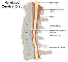 Herniated cervical disc diagram for slip disc condition
