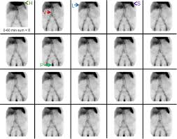 GI bleeding scintigraphy image sequence in nuclear medicine