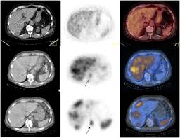 Neuroendocrine tumors PET-CT and SPECT imaging panels used for diagnosis and follow-up