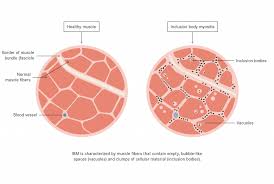 Myositis care
