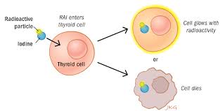 Radioiodine I-131 therapy diagram showing radioactive iodine targeting thyroid cells