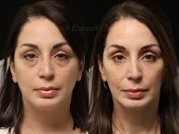 Eyelid surgery (blepharoplasty) — before and after comparison