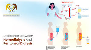 Difference between hemodialysis and peritoneal dialysis illustration
