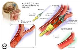 Stroke intervention procedure diagram showing clot retrieval