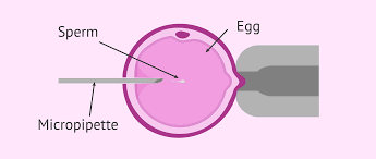ICSI diagram showing sperm injection into egg with micropipette