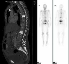 Bone metastasis imaging with sagittal CT and whole-body nuclear medicine bone scan views