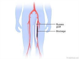 Peripheral bypass surgery