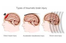 Types of traumatic brain injury diagram for head injury condition