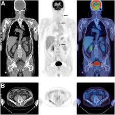 Lymphoma PET-CT fusion imaging used for staging and response assessment