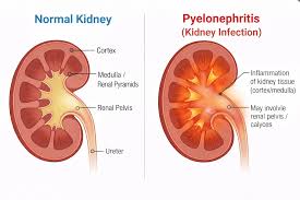 Kidney infection pyelonephritis versus normal kidney diagram