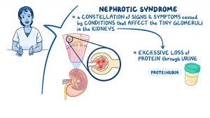 Nephrotic syndrome overview illustration