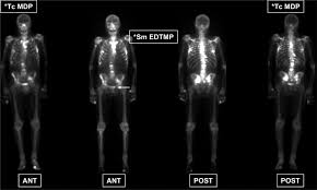 Bone pain palliation therapy scan image used in metastatic bone disease management