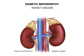 Diabetic nephropathy and normal kidney comparison image