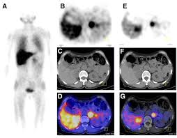 Nuclear infection localization scan with fused PET-CT images